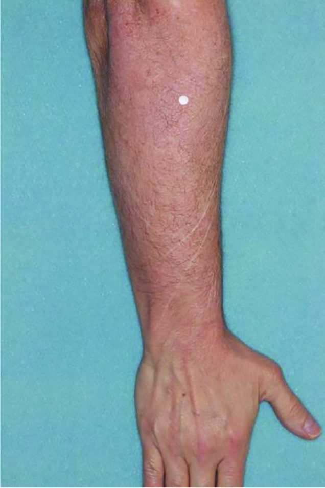 Before and after images of plaque psoriasis on the arm