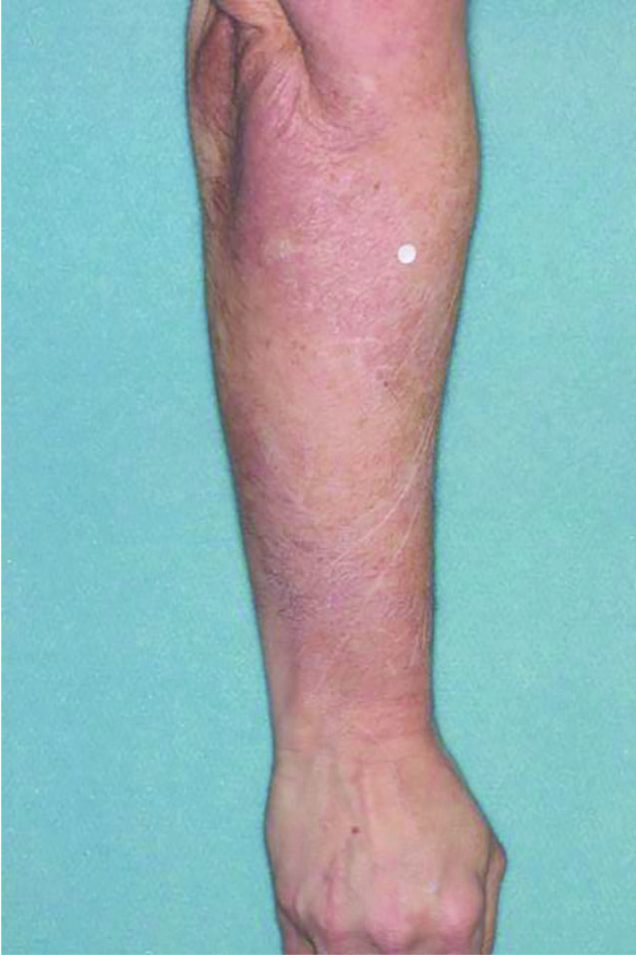 Before and after images of plaque psoriasis on the arm