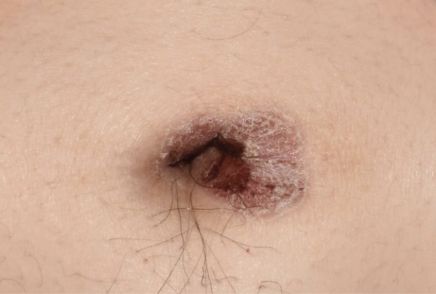Before and after images of plaque psoriasis (belly button)