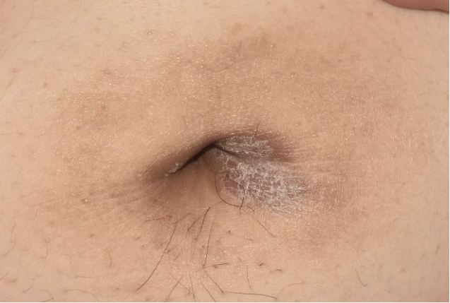Before and after images of plaque psoriasis (belly button)