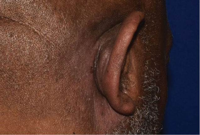 Before and after images of plaque psoriasis (behind the ear)
