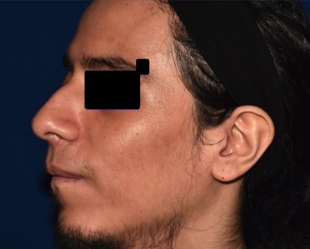 Before and after images of plaque psoriasis (face)