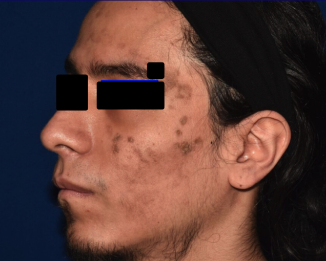 Before and after images of plaque psoriasis (face)