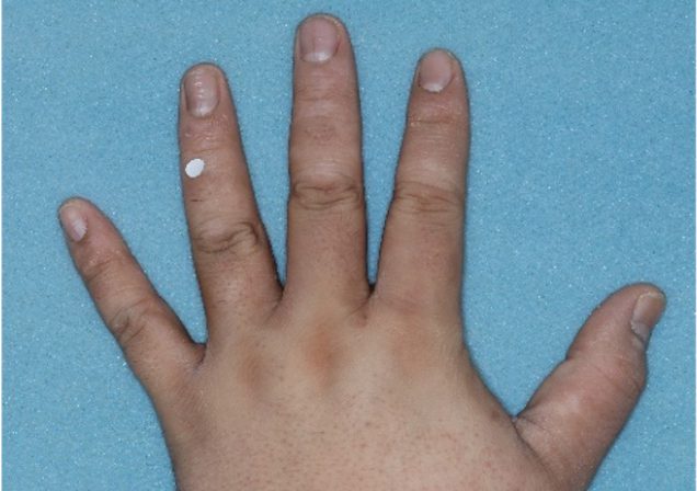 Before and after images of plaque psoriasis on the hand