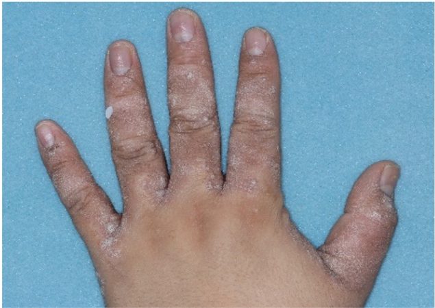 Before and after images of plaque psoriasis on the hand