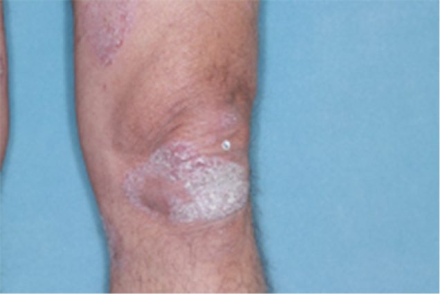 Before and after images of plaque psoriasis on the knee
