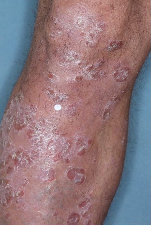 Before and after images of plaque psoriasis on the lower leg