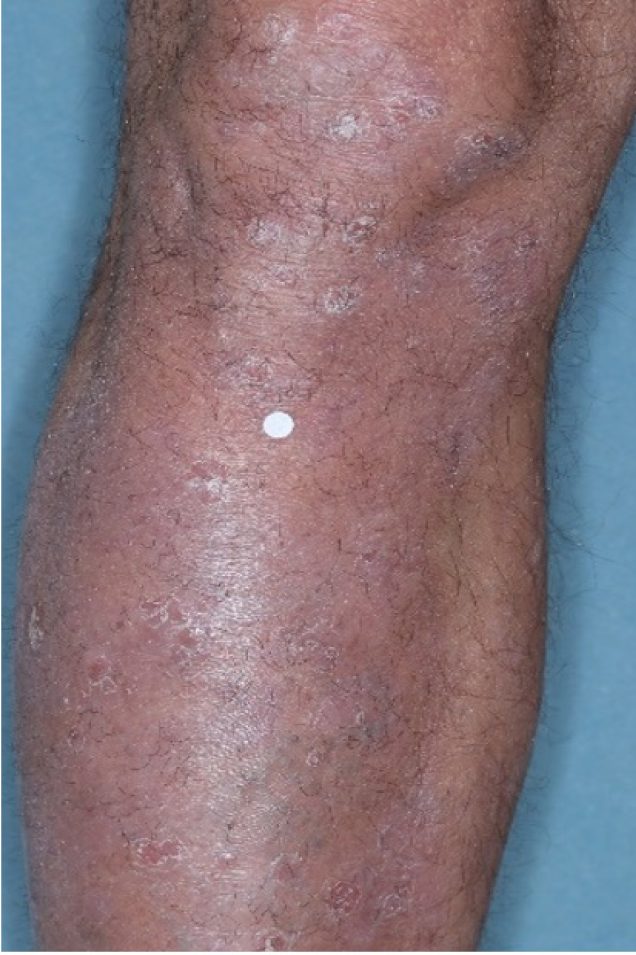 Before and after images of plaque psoriasis on the lower leg