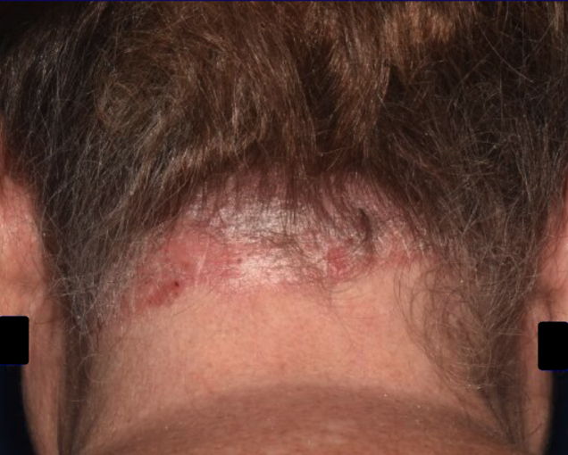 Before and after images of plaque psoriasis (scalp)
