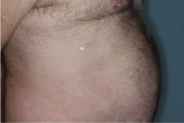 Before and after images of plaque psoriasis on the abdomen